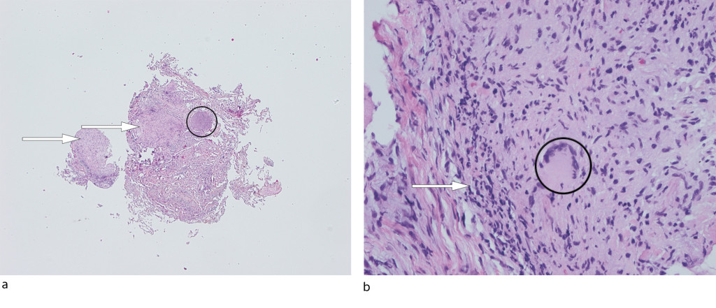 Figure 2 Lung biopsy, routine staining with haematoxylin and eosin. a) 40x magnification: lung tissue with granulomatous…