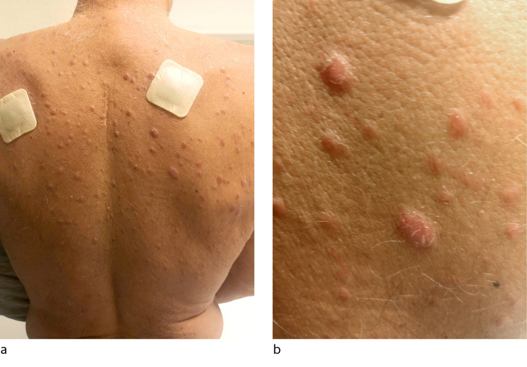 Figure 1 Multiple pink papules distributed over the back