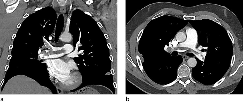 Figure 1 Coronal (a) and axial (b) sections on a CT pulmonary angiogram show widespread emboli in the pulmonary trunk as…