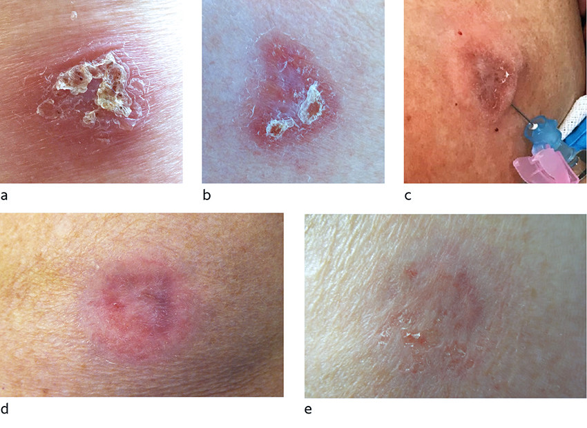 Figure 2 Cutaneous leishmaniasis on the upper arm caused by L. (L.) infantum. a) prior to liposomal amphotericin B, b) seven…