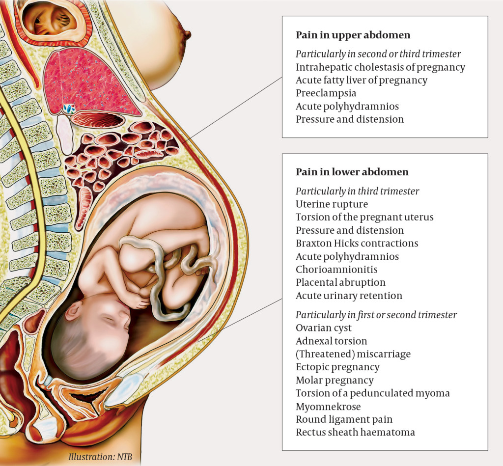 Figure 1 Gynaecological diagnoses to consider in cases of acute abdomen in pregnancy. The risk assessment will depend on…