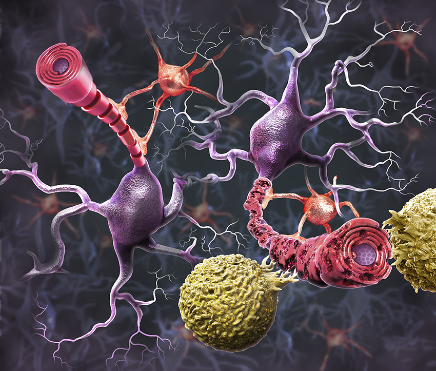 Illustrasjon av den autoimmune responsen og skaden som forårsaker nevrodegenerative sykdommer som multippel sklerose. Til…