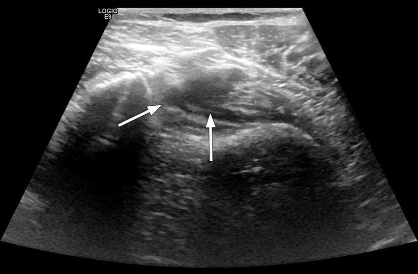 Figure 1 Ultrasound image of right lower extremity, patient examined with legs hanging over the edge of the bed. Distal…