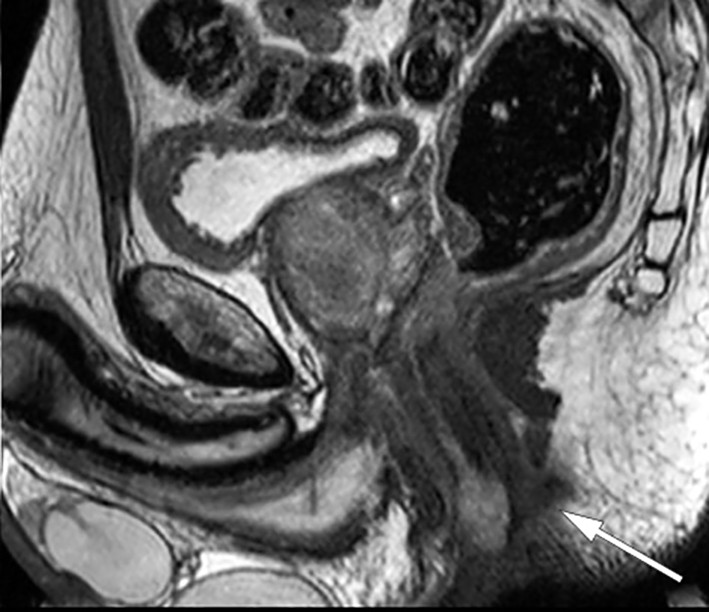 Figure 1 MRI, sagittal view of pelvis. Tumour can be seen in the lower anal canal (arrow).