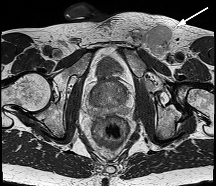 Figure 2 MRI, axial view of pelvis, with enlarged lymph node in left inguinal region (arrow).