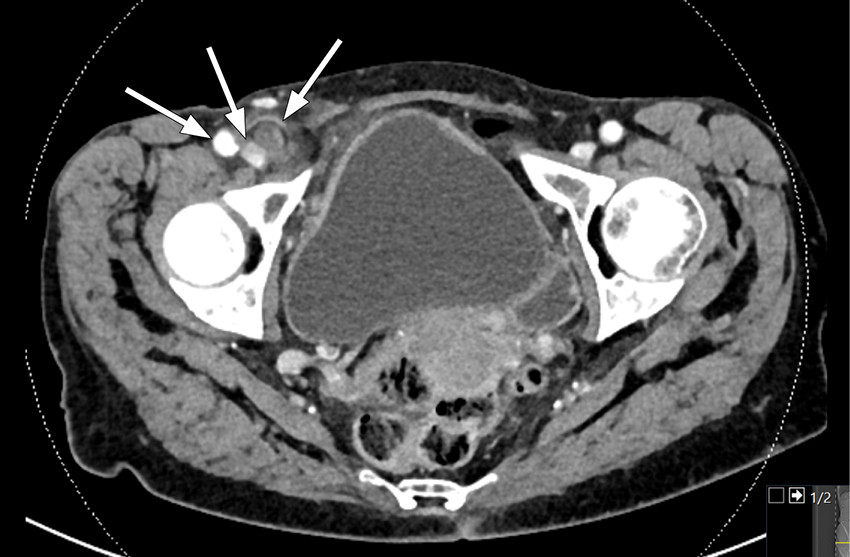 Figure 1 Axial CT  scan showing a superficial tubular structure in the right fossa with adjacent adipose tissue remodelling,…