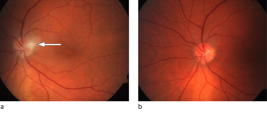 Figure 1 Fundus image of the patient's left eye at the time of diagnosis (a) and after six weeks of treatment (b). White…
