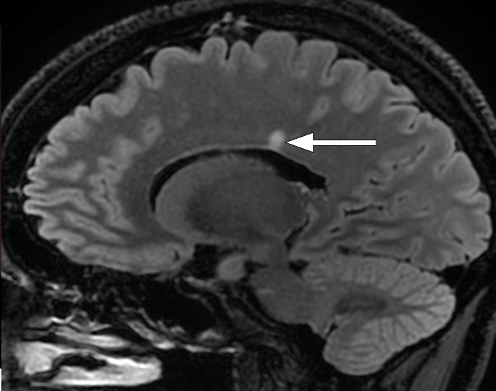 Figure 3 MRI of the head with a FLAIR (fluid-attenuated inversion recovery) sequence in the sagittal plane shows a…