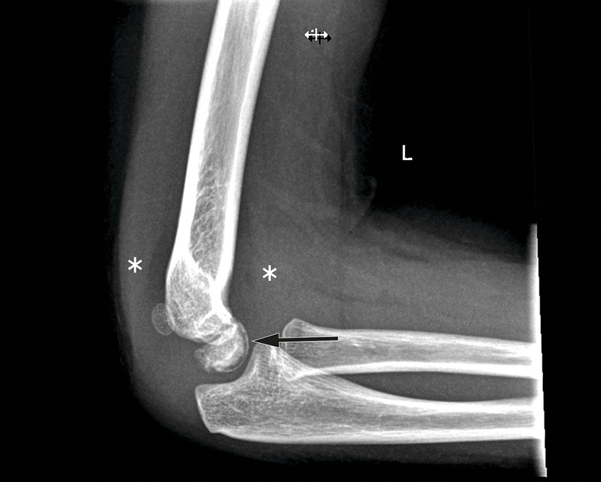 X-ray radiograph showing a radiolucent line (black arrow) corresponding to small gas bubbles visible in the same location on…