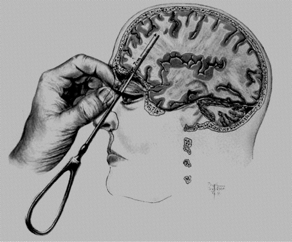 Figur 2 Tegning fra boken «Psychosurgery» av Freeman and Watts, 1950, som viser hvordan prefrontal lobotomy ble utført (2)…