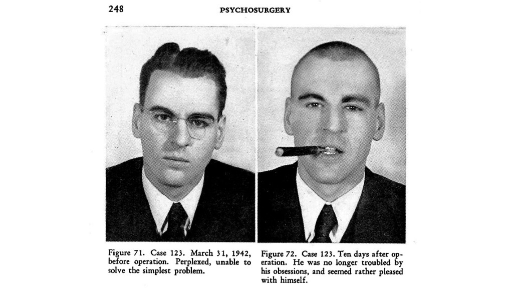 Figur 3 Typisk pasienthistorie i boken «Psychosurgery» av Freeman and Watts, 1950 (2). Faksimile
