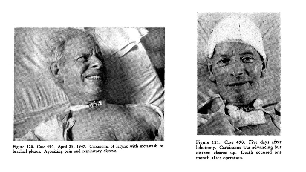 Figur 4 Lobotomi brukt som palliasjon, «Psychosurgery» av Freeman and Watts, 1950 (2). Faksimile