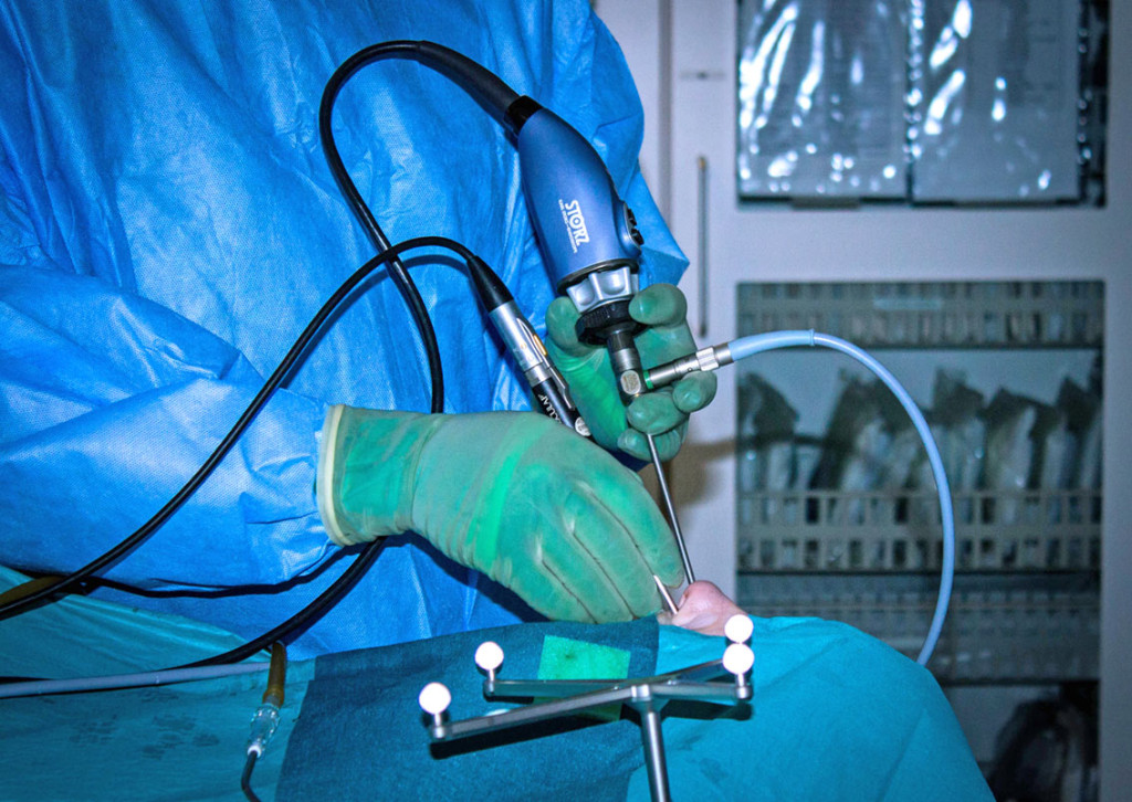 Figure 2 Endoscopic two-hands technique. The surgeon controls the camera with their left hand and operates with their right…