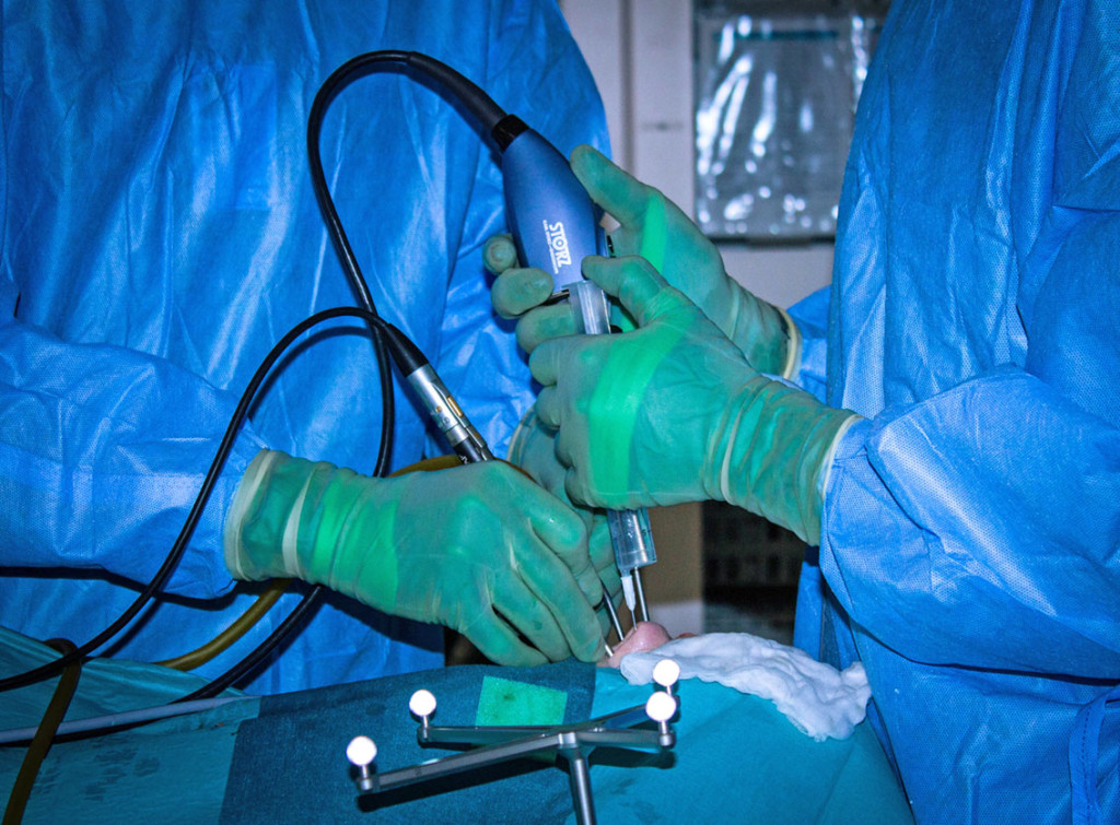 Figure 3 Endoscopic four-hands technique with two surgeons working together. One uses both hands to dissect, the other…