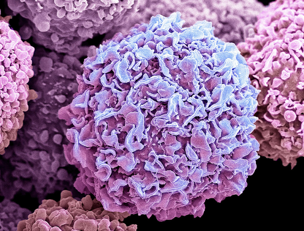 Et farget bilde fra skanningelektronmikroskop (SEM) av brystkreftceller. Illustrasjonsfoto: Science Photo Library / NTB