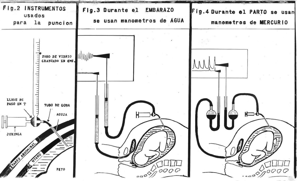 Figur 3 Roberto Caldeyro-Barcias doktorarbeid Contractility of the human uterus during pregnancy and childbirth. Foto:…