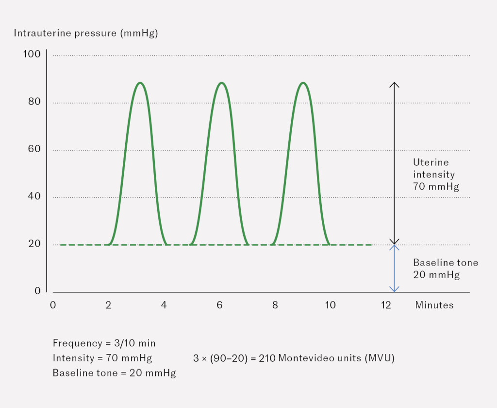 Figure 2 Montevideo units (MVU) are a standard measurement of uterine activity during labour, with a value of 200 MVU…