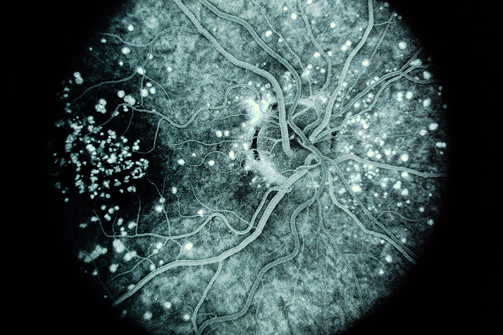 Makuladegenerasjon i h&oslash;yre &oslash;ye, fluoresceinangiografi. Illustrasjonsfoto: Alan Frohlichstein / Science Photo Library / NTB