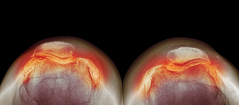 Kneleddsartrose, hos en 73&nbsp;&aring;r gammel kvinne. Illustrasjonsfoto: DR P. Marazzi / Science Photo Library / NTB