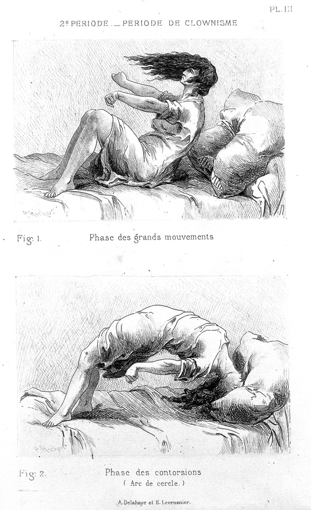 &Eacute;tudes cliniques sur l'hyst&eacute;ro-&eacute;pilepsie ou grande hyst&eacute;rie (1881), av Paul Richer (1849&ndash;1933). Illustrasjonsfoto: Wellcome&hellip;