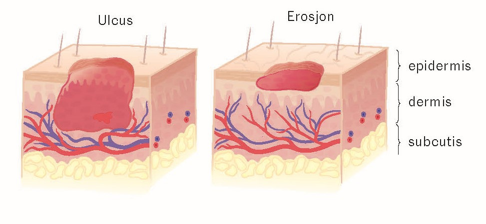 Figur 1 Skisse av hud med et ulcus, der vevstapet g&aring;r ned i dermis, og en erosjon, der vevstapet er begrenset til epidermis&hellip;