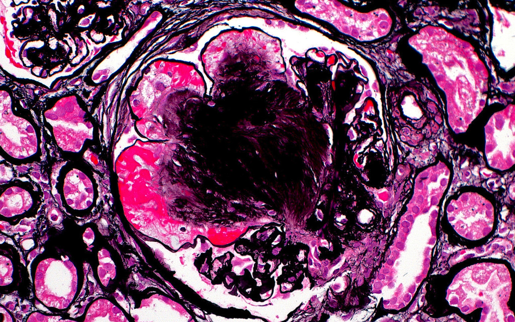 Nyre med diabetes, lysmikroskop. Illustrasjonsfoto: Science Photo Library / NTB
