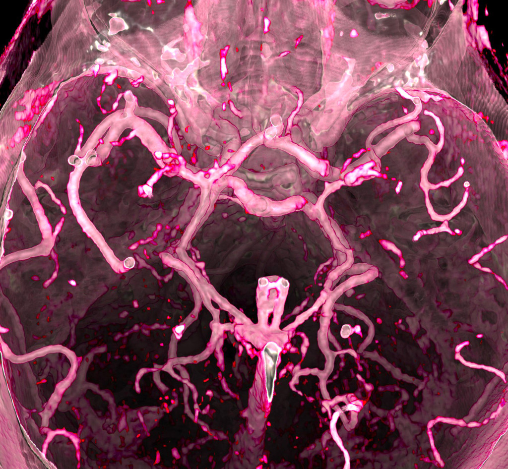 Iskemisk hjerneslag, MR. Illustrasjonsfoto: Vsevolod Zviryk / Science Photo Library / NTB