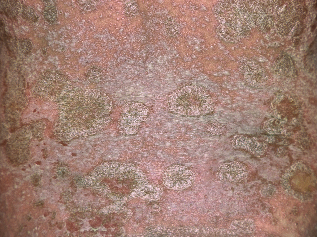 Pustul&oslash;s psoriasis, n&aelig;rbilde av rygg. Foto: PDC / Science Photo Library / NTB